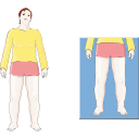 Venous Edema Illustration 4