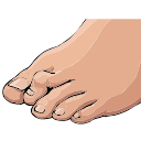 Hammertoe