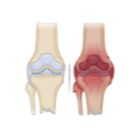 Normal And Arthritis Joint