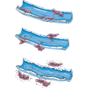 Localized Edema Illustration 3