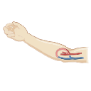 Av Arteriovenous Fistula Dialysis
