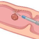 Colonoscopy Snare Polyp