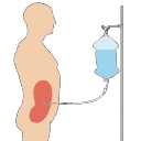 Peritoneal Dialysis Set Up