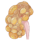 Adult Polycystic Kidney Disease