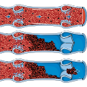 Venous Thrombosis Blood Clot 2