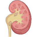 Renal Or Kidney Stones Urolithiasis