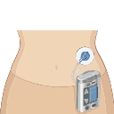 Insulin Pump