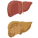 Liver Cirrhosis And Normal