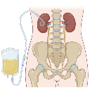 Nephrostomy Tube