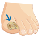 Fungus Toe Onychomycosis
