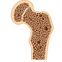 Osteoporosis Femur Bone