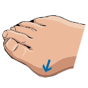 Bunion