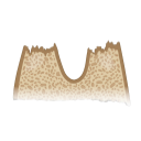 Bone Surface Osteolytic