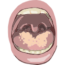 Free Illustration Chronic Mucocutaneous Candidiasis