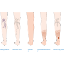 Venous Disease Illustration